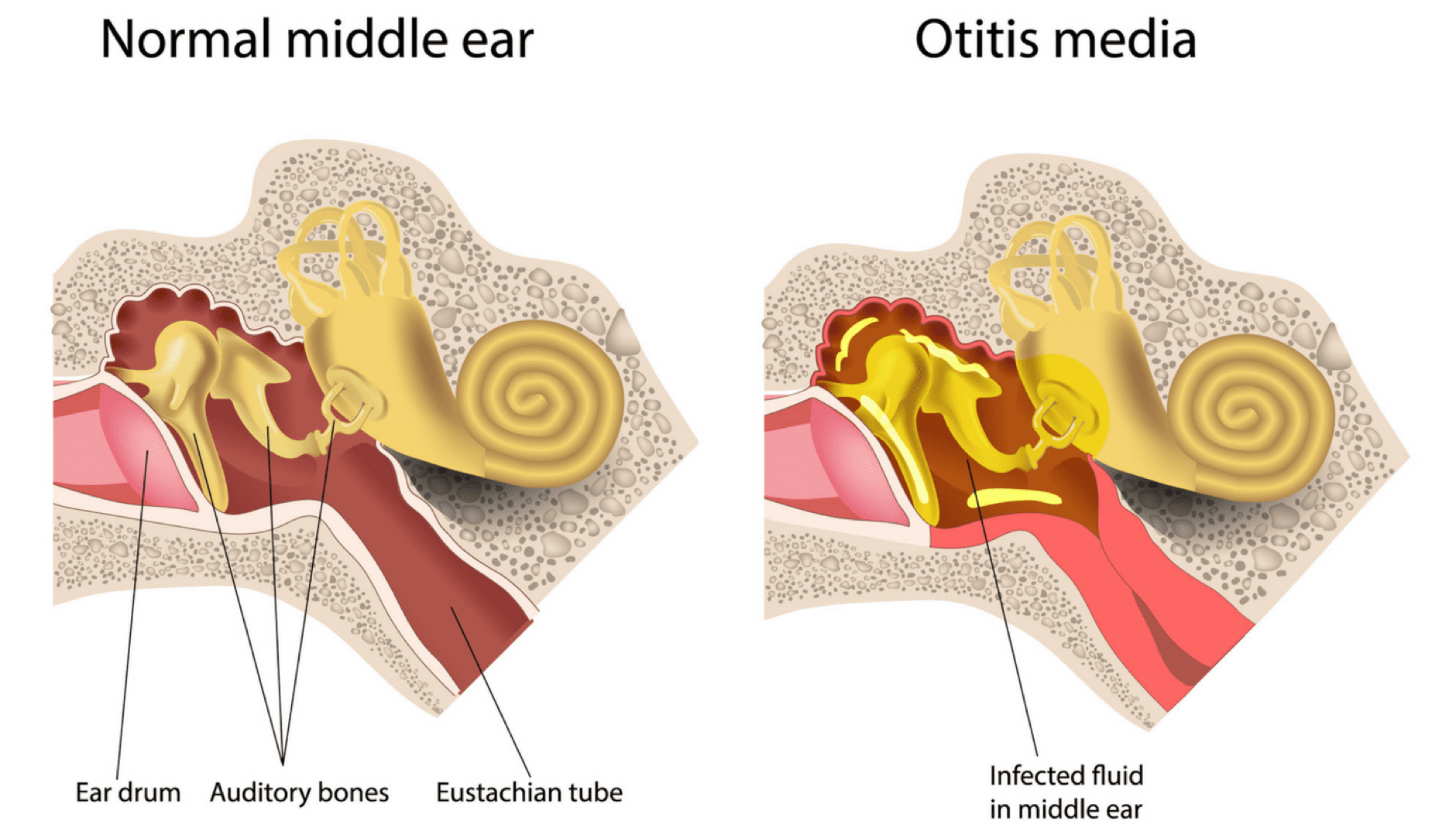 Otitis Media Middle Ear Infection Causes And Treatment